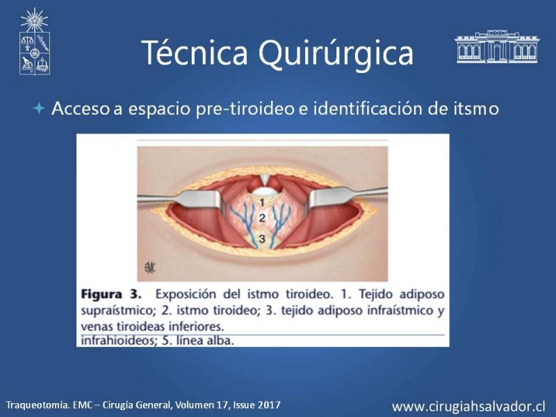 Diapositiva 9 de Traqueostomía