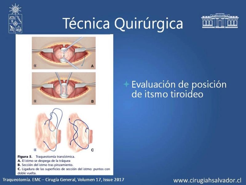 Diapositiva 11 de Traqueostomía