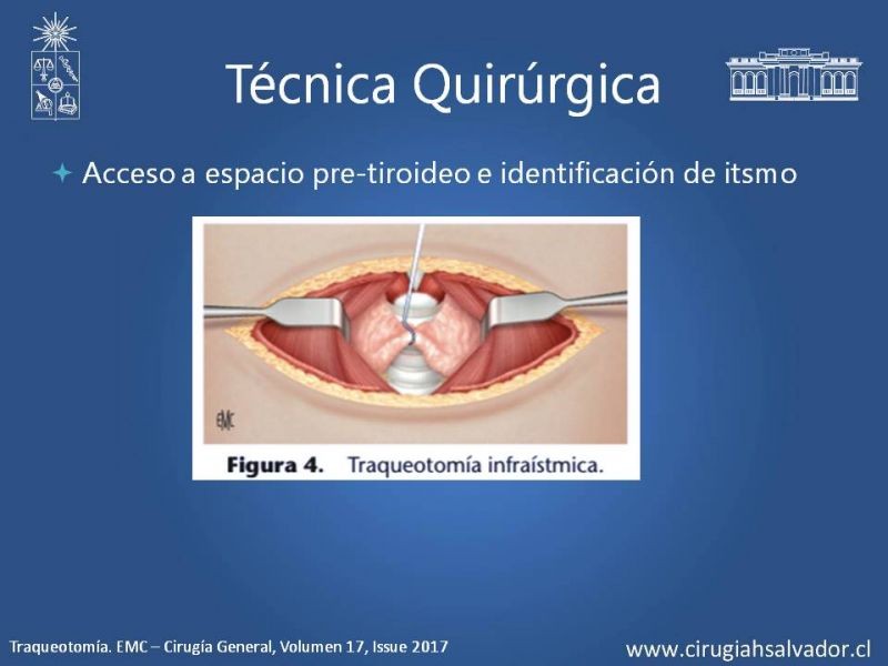 Diapositiva 10 de Traqueostomía