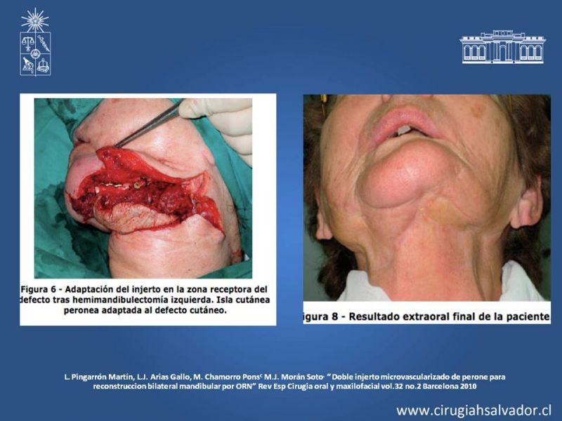 Diapositiva 25 de Osteoradionecrosis