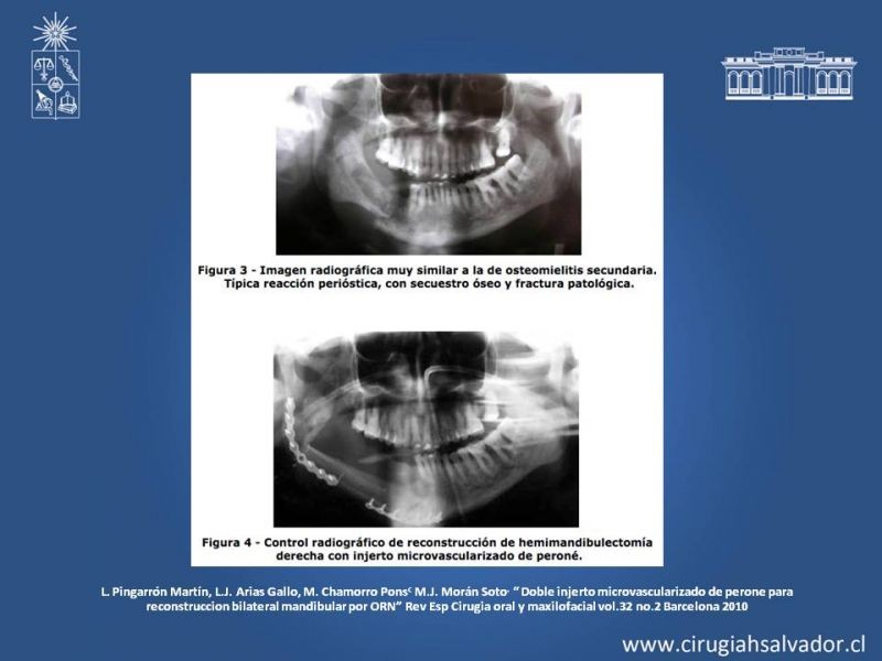 Diapositiva 24 de Osteoradionecrosis