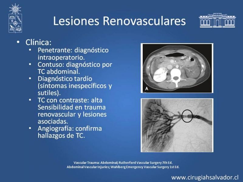 Diapositiva 34 de Lesión Vascular Abdominal