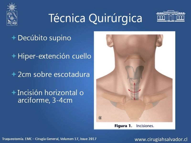 Diapositiva 7 de Traqueostomía