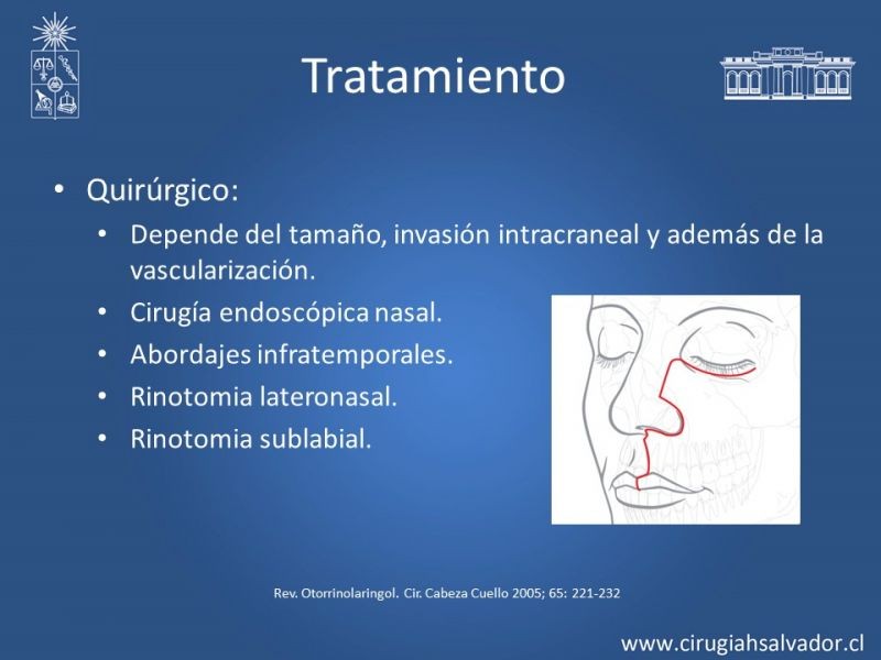 Diapositiva 14 de Tumores de Rinofaringe