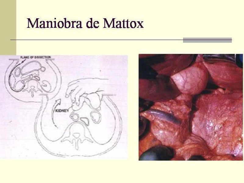 Diapositiva 30 de Lesiones Vasculares Abdominales