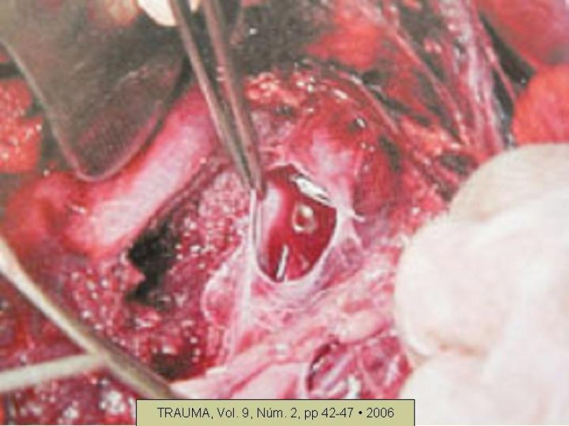 Diapositiva 36 de Lesiones Vasculares Abdominales