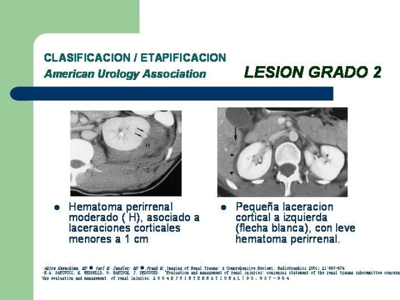 Diapositiva 17 de Traumatismo renal