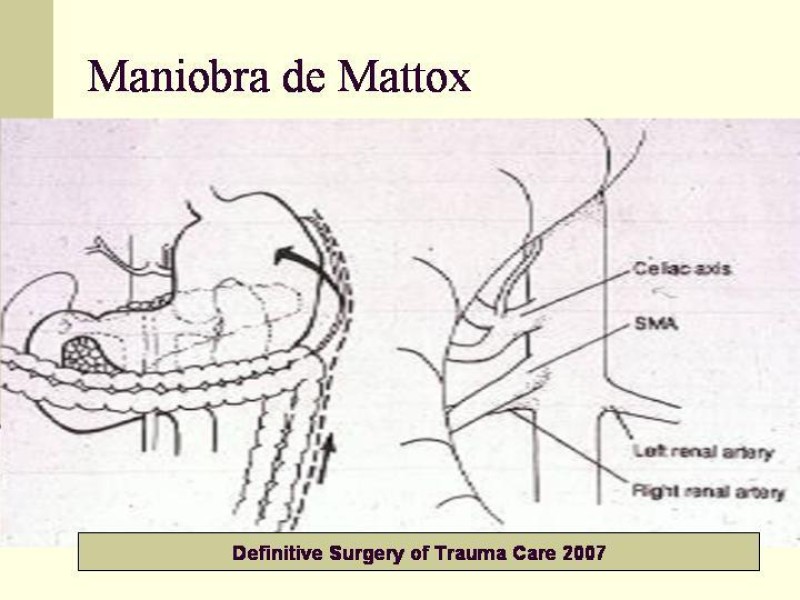 Diapositiva 29 de Lesiones Vasculares Abdominales