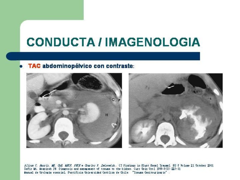 Diapositiva 10 de Traumatismo renal