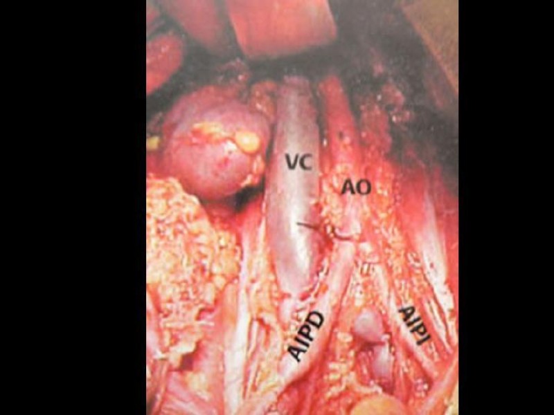 Diapositiva 28 de Lesiones Vasculares Abdominales