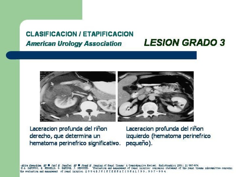 Diapositiva 19 de Traumatismo renal