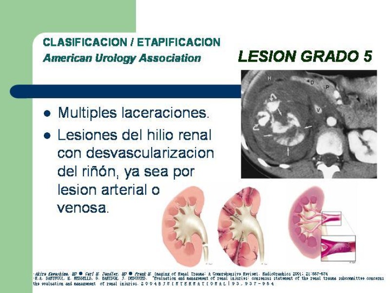 Diapositiva 22 de Traumatismo renal