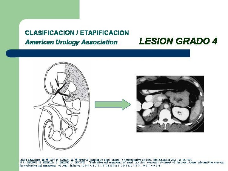 Diapositiva 21 de Traumatismo renal