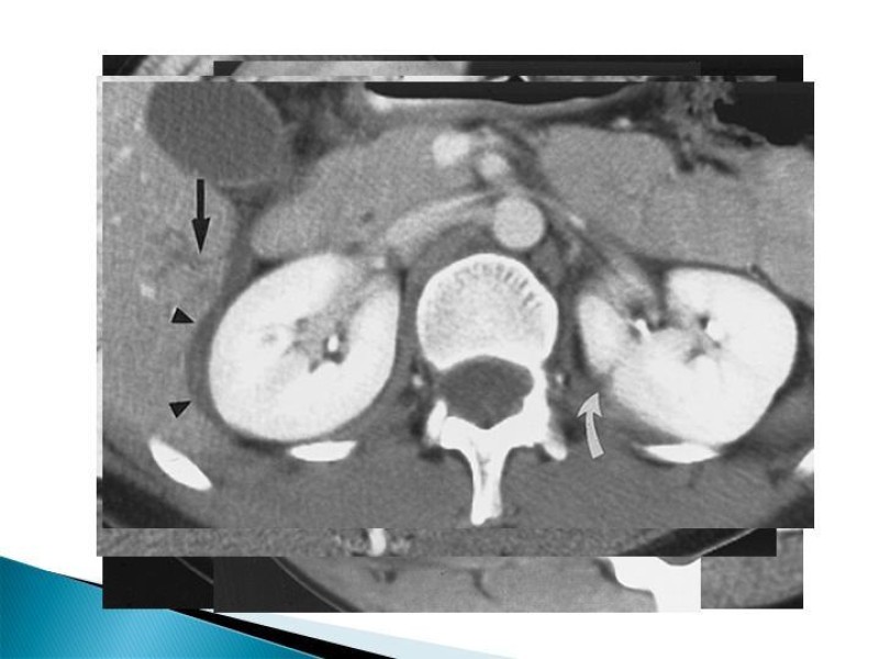 Diapositiva 9 de Trauma renal