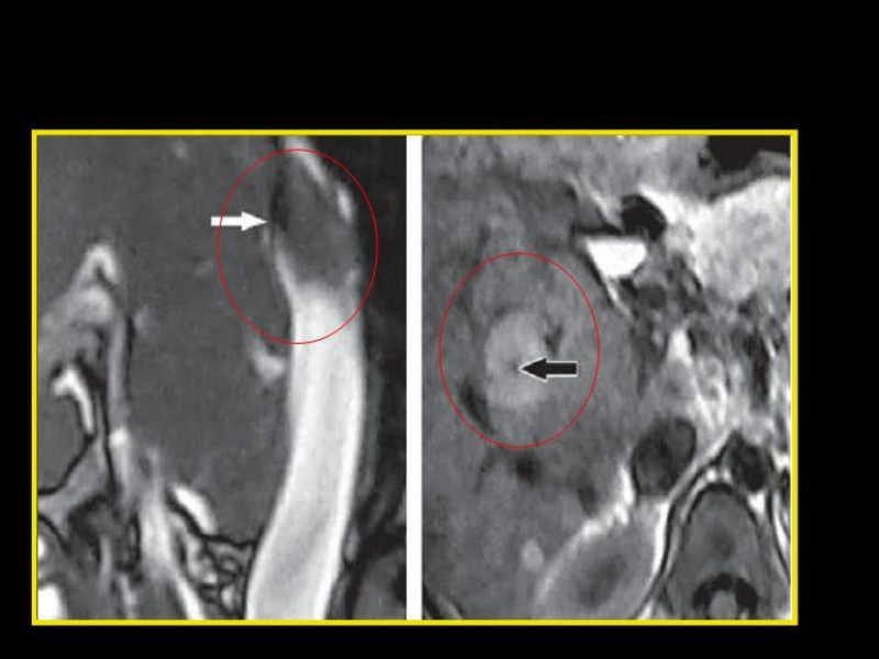 Diapositiva 17 de Sindrome de Budd-Chiari