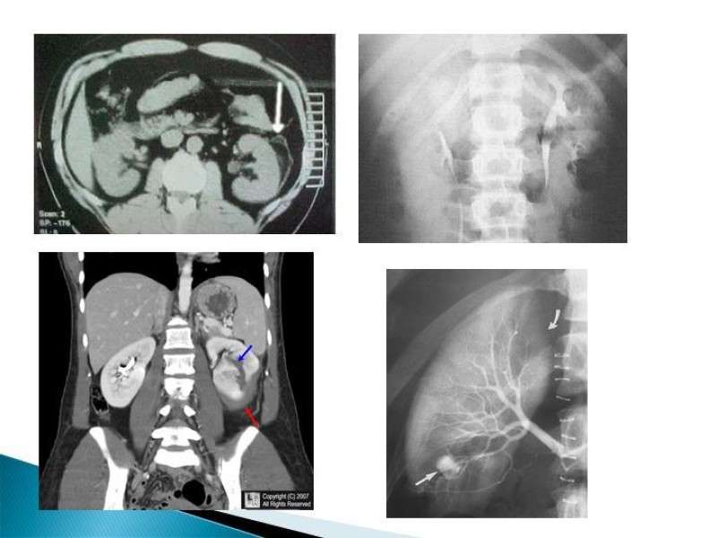 Diapositiva 6 de Trauma renal