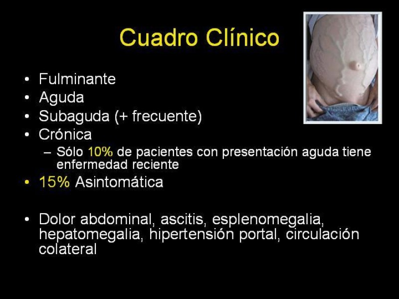 Diapositiva 12 de Sindrome de Budd-Chiari