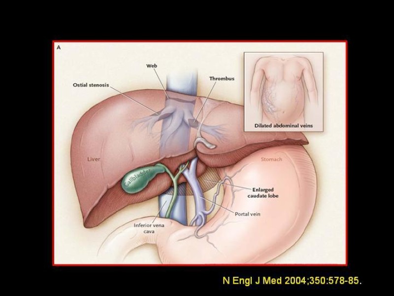 Diapositiva 4 de Sindrome de Budd-Chiari