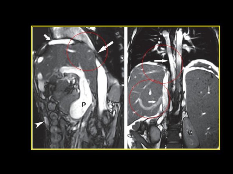 Diapositiva 16 de Sindrome de Budd-Chiari