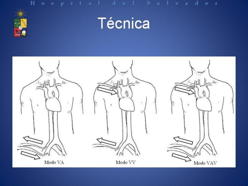 Diapositiva 14 de ECMO : Extra Corporeal Membrane Oxigenation