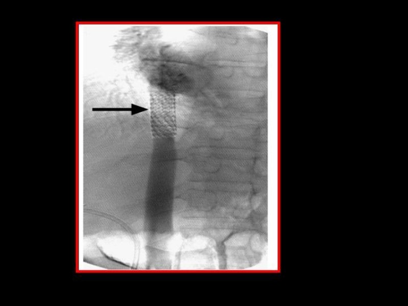 Diapositiva 21 de Sindrome de Budd-Chiari