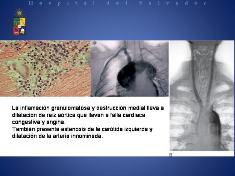 Diapositiva 5 de Enfermedad de Takayasu