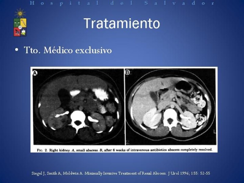 Diapositiva 27 de Manejo de los Abscesos Renales y Perinefríticos a propósito de un caso clínico
