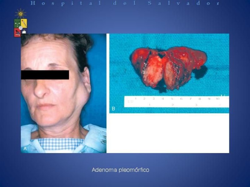 Diapositiva 17 de Masa cervical