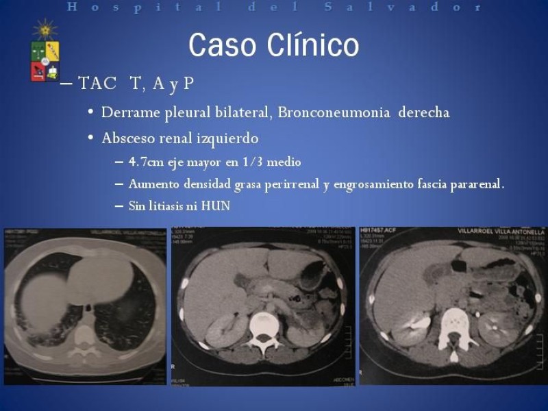 Diapositiva 4 de Manejo de los Abscesos Renales y Perinefríticos a propósito de un caso clínico
