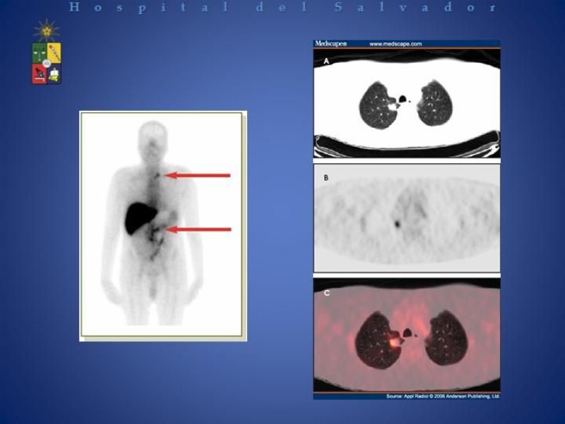 Diapositiva 8 de Linfadenectomía Ampliada vs Estándar en Cáncer de Próstata