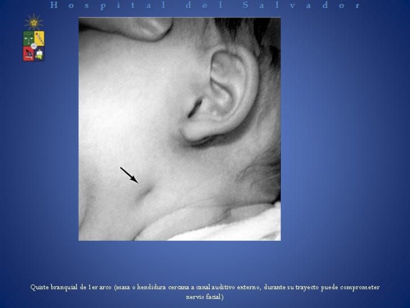 Diapositiva 9 de Masa cervical