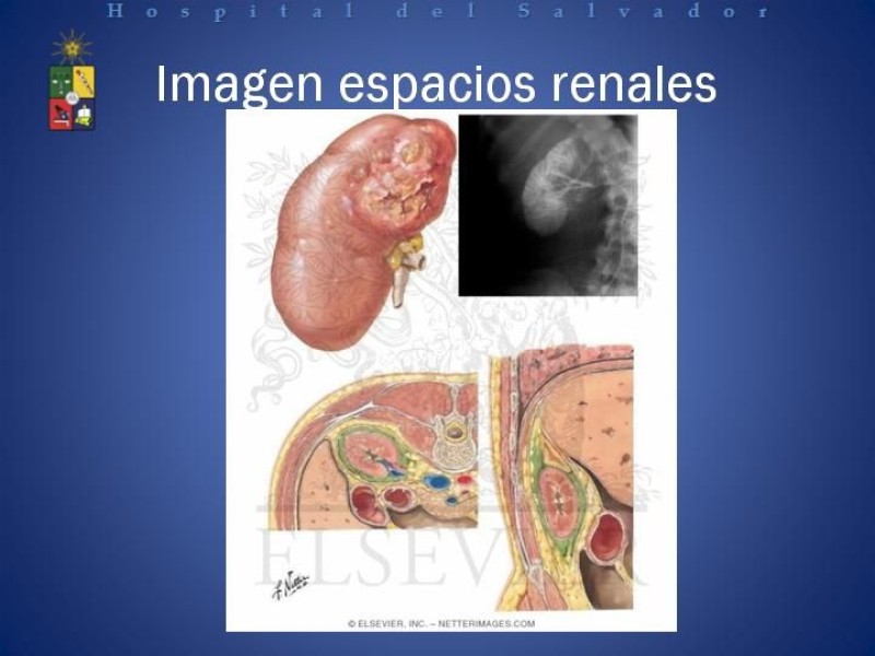 Diapositiva 15 de Manejo de los Abscesos Renales y Perinefríticos a propósito de un caso clínico