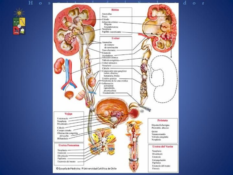Diapositiva 19 de Manejo de los Abscesos Renales y Perinefríticos a propósito de un caso clínico