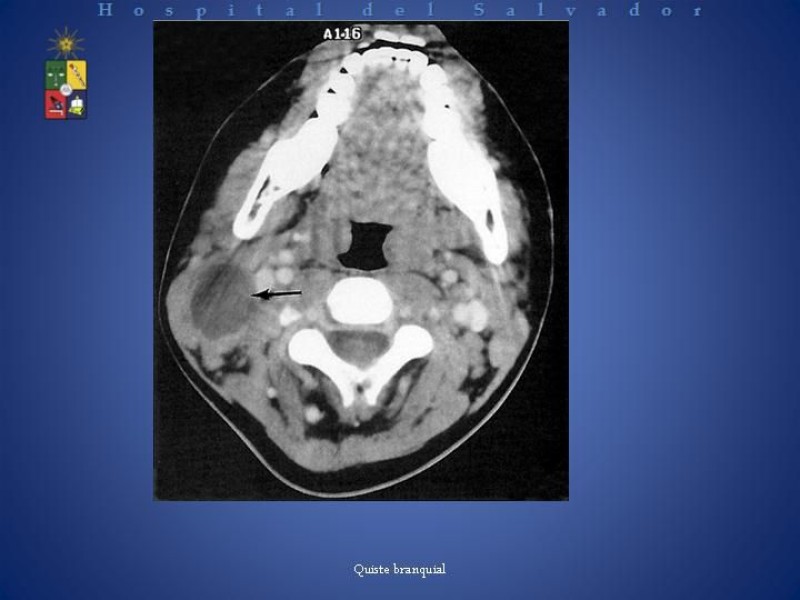 Diapositiva 8 de Masa cervical