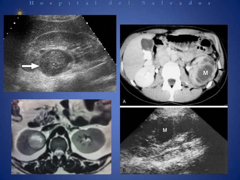 Diapositiva 22 de Manejo de los Abscesos Renales y Perinefríticos a propósito de un caso clínico