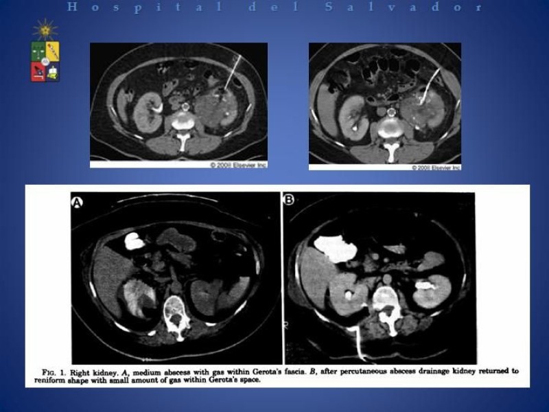 Diapositiva 30 de Manejo de los Abscesos Renales y Perinefríticos a propósito de un caso clínico