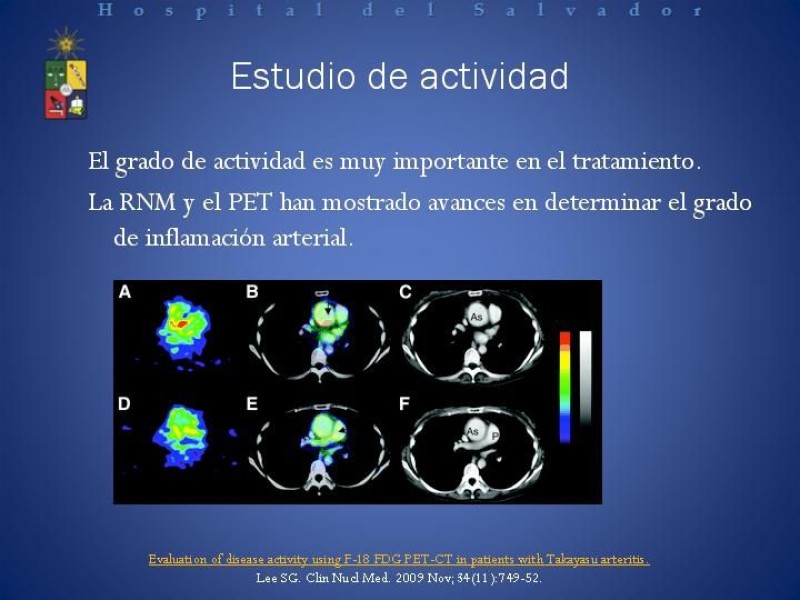 Diapositiva 9 de Enfermedad de Takayasu