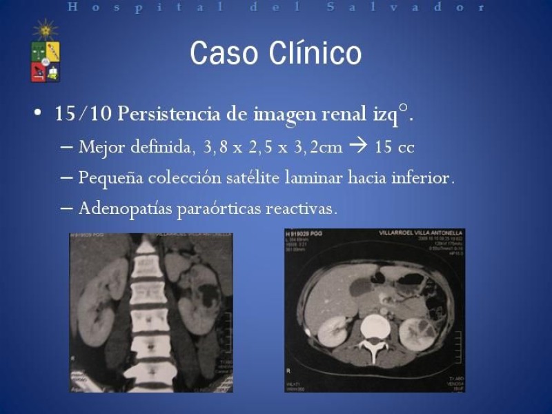 Diapositiva 7 de Manejo de los Abscesos Renales y Perinefríticos a propósito de un caso clínico