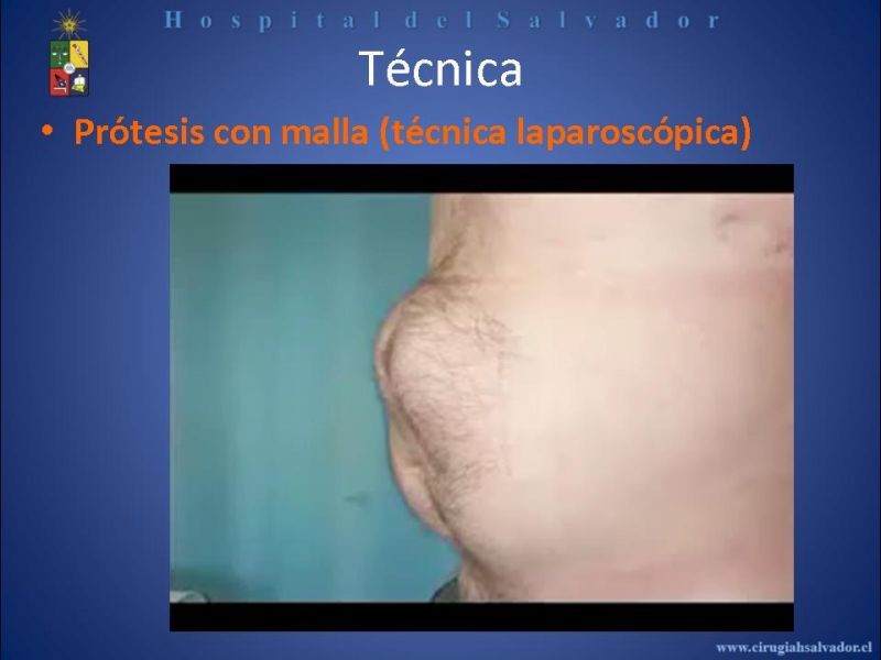 Diapositiva 21 de Reparación Laparoscópica de hernias incisionales