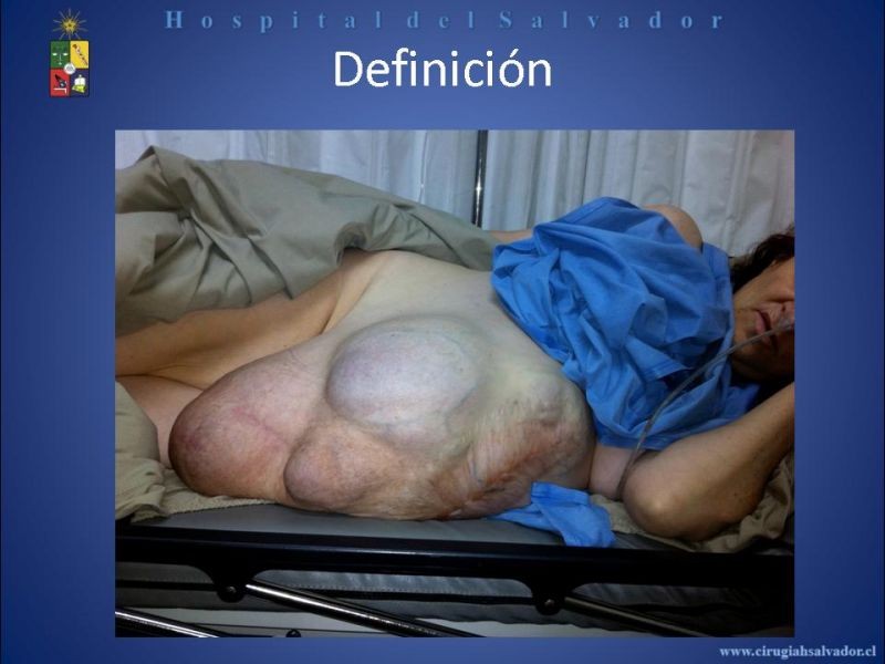 Diapositiva 5 de Reparación Laparoscópica de hernias incisionales
