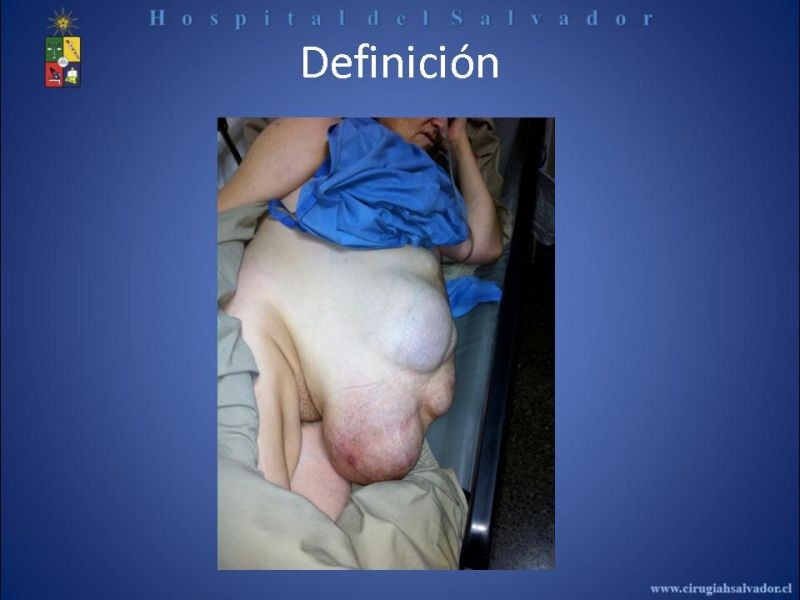 Diapositiva 6 de Reparación Laparoscópica de hernias incisionales