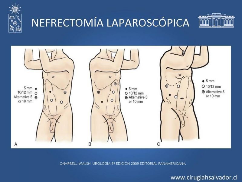 Diapositiva 21 de Nefrectomía técnica quirúrgica