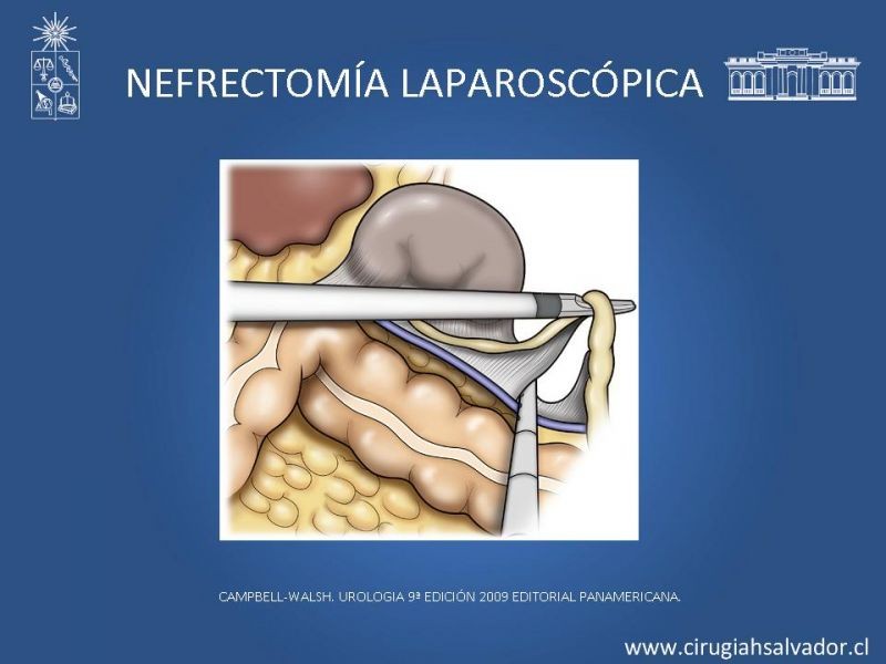 Diapositiva 24 de Nefrectomía técnica quirúrgica