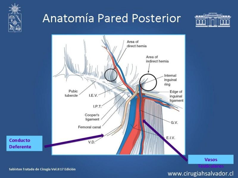 Diapositiva 6 de Alternativas actuales en el tratamiento de la Hernia Inguinal