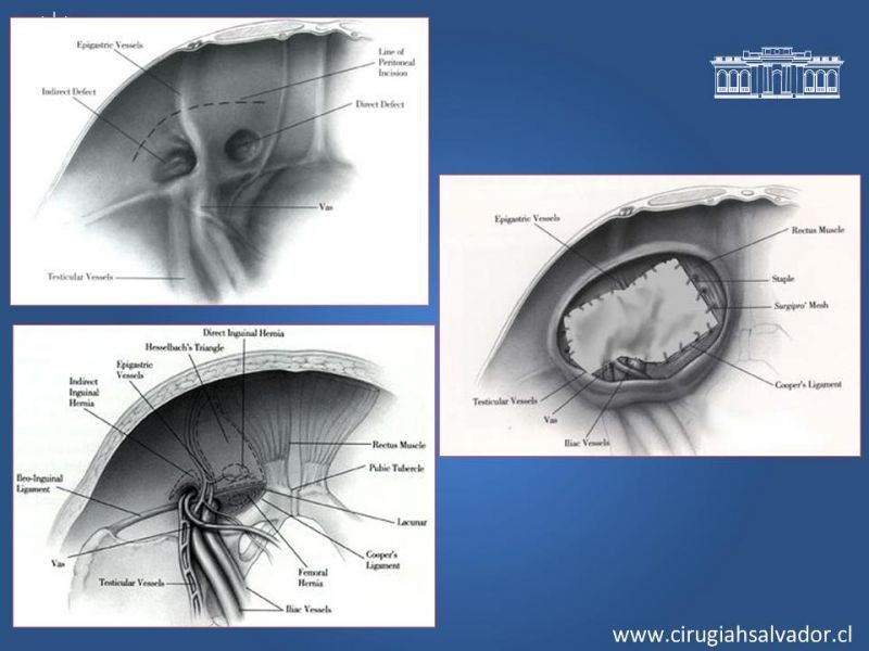 Diapositiva 22 de Alternativas actuales en el tratamiento de la Hernia Inguinal