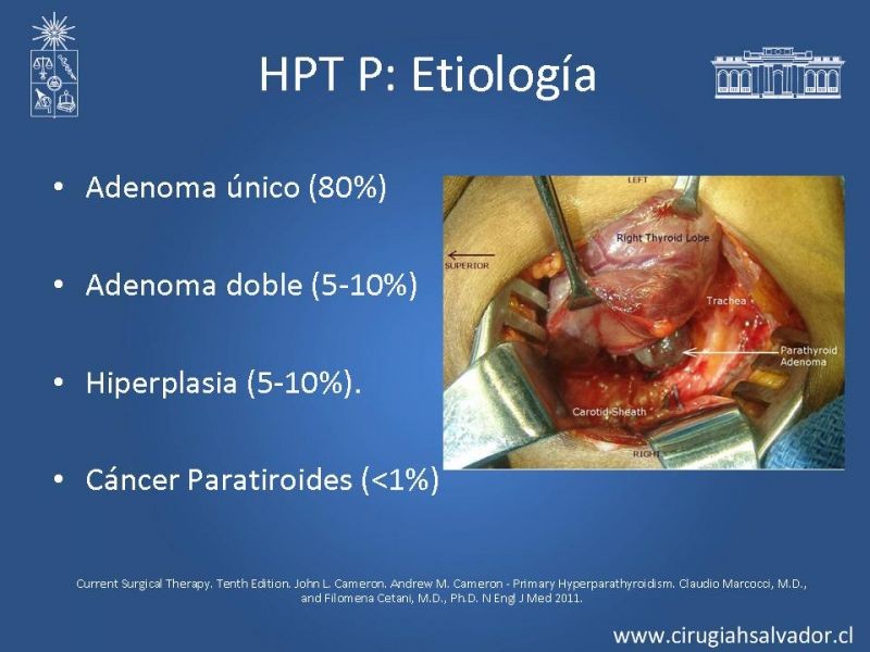 Diapositiva 4 de Hiperparatiroidismo Primario