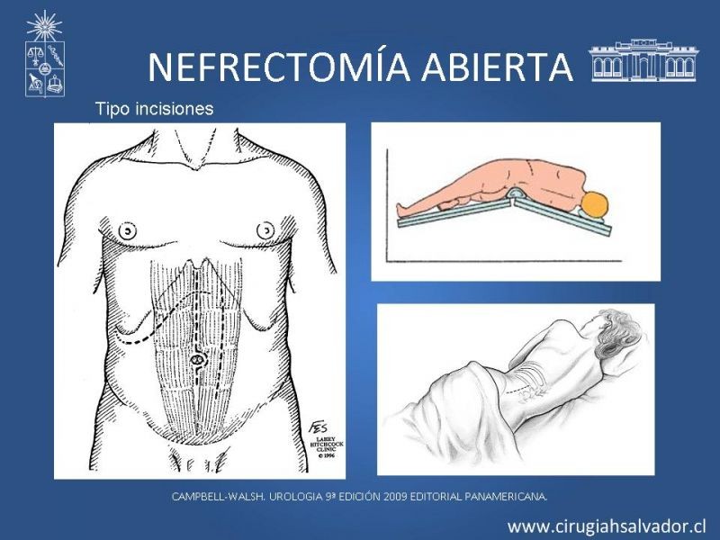 Diapositiva 7 de Nefrectomía técnica quirúrgica