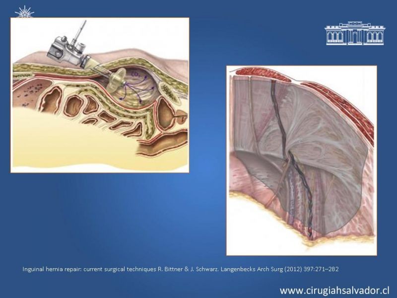 Diapositiva 25 de Alternativas actuales en el tratamiento de la Hernia Inguinal