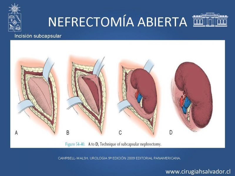 Diapositiva 9 de Nefrectomía técnica quirúrgica
