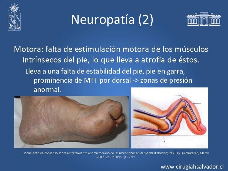 Diapositiva 7 de Pie Diabético